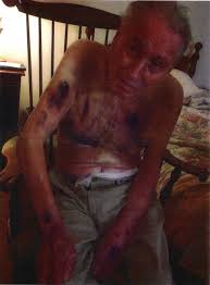 Two Residents Repeatedly Abused At Morris County Assisted Living